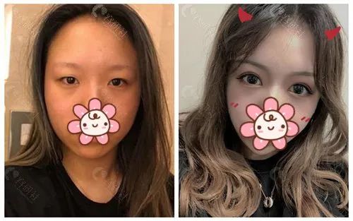 上海美莱双眼皮手术对比照
