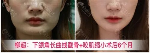 广州广大柳超做下颌角长曲线靠谱吗