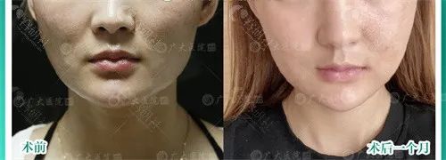 广州广大柳超做下颌角磨骨改善宽脸好不好