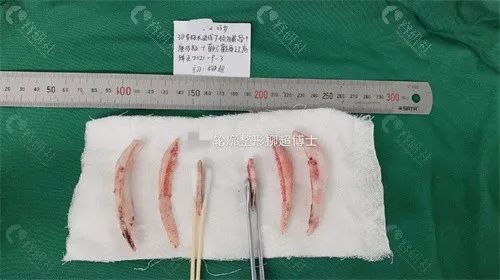 广州广大柳超切下的下颌角
