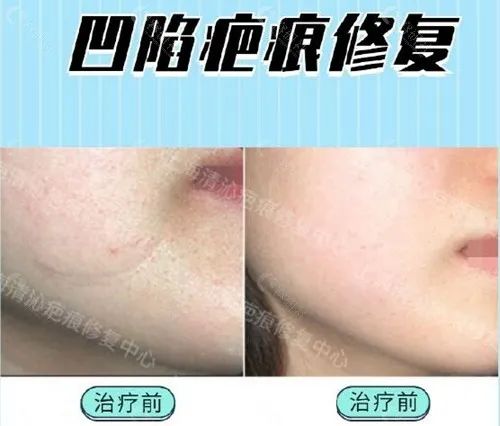 上海清沁凹陷疤痕修复前后对比照