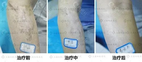 上海虹桥疤痕修复真人效果图