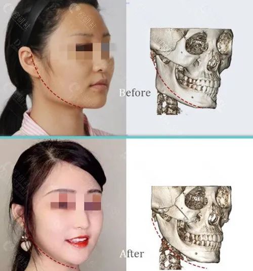 上海愉悦美联臣曹栋弼磨下颌角前后对比照