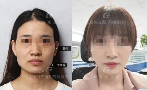 上海时光何晋龙磨下颌角术前术后对比
