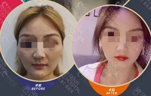 上海仁爱医院刘先超长曲线下颌角术前术后对比