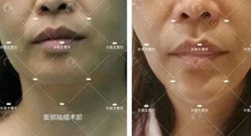 上海百达丽面部吸脂效果图