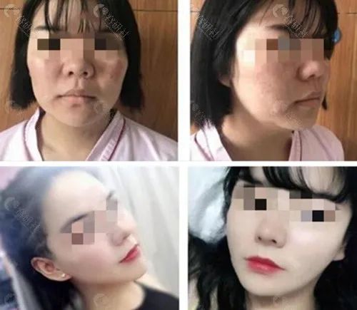 上海伯思立面部吸脂真人效果图